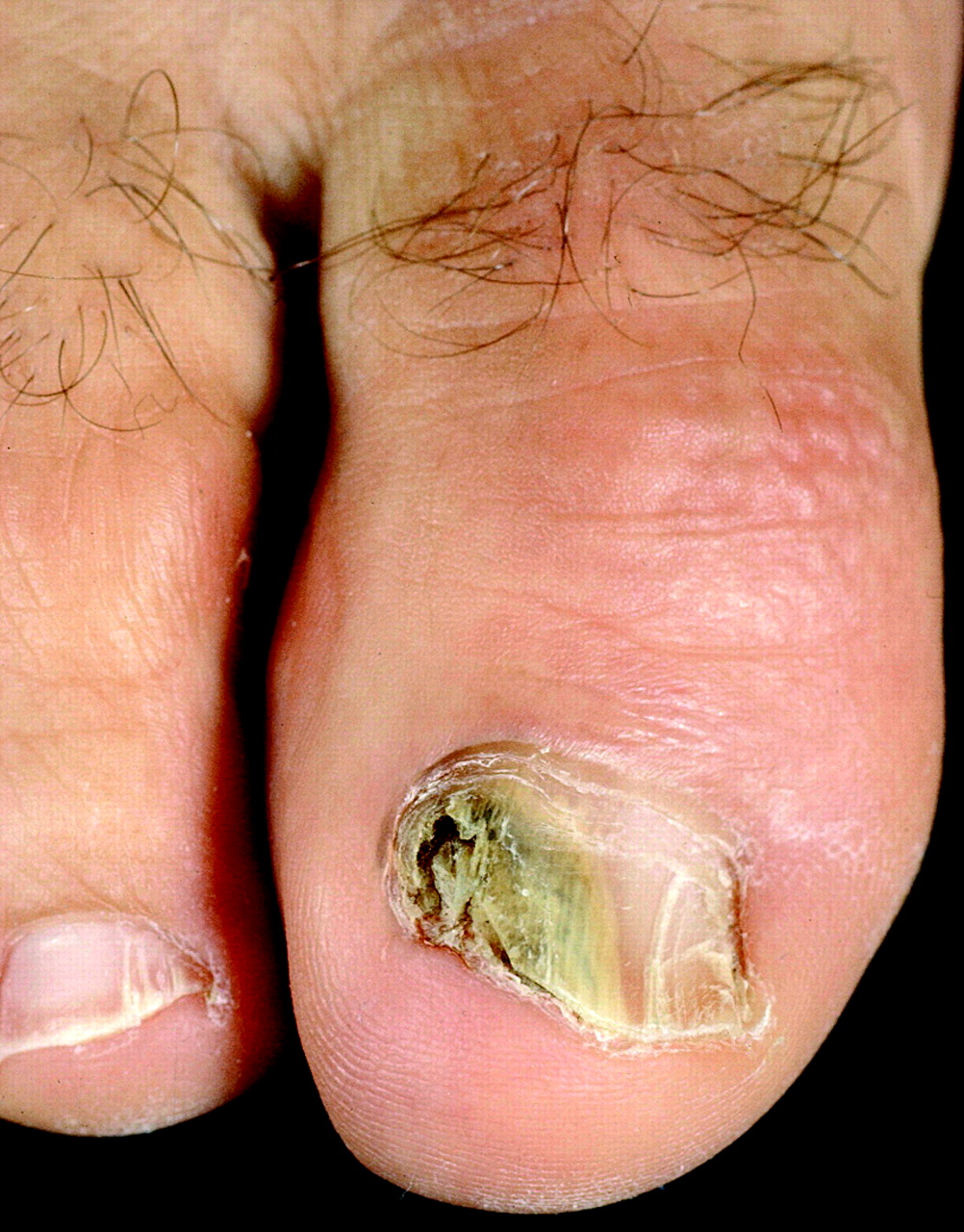 Nail infections