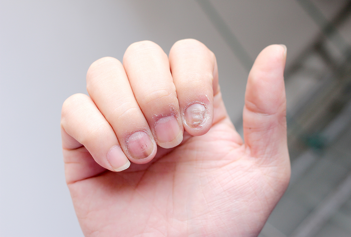 Nail infections