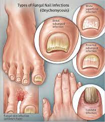 Nail infections