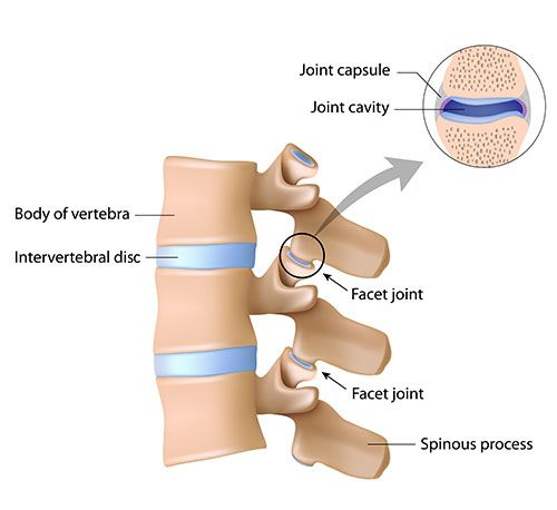 Neck pain