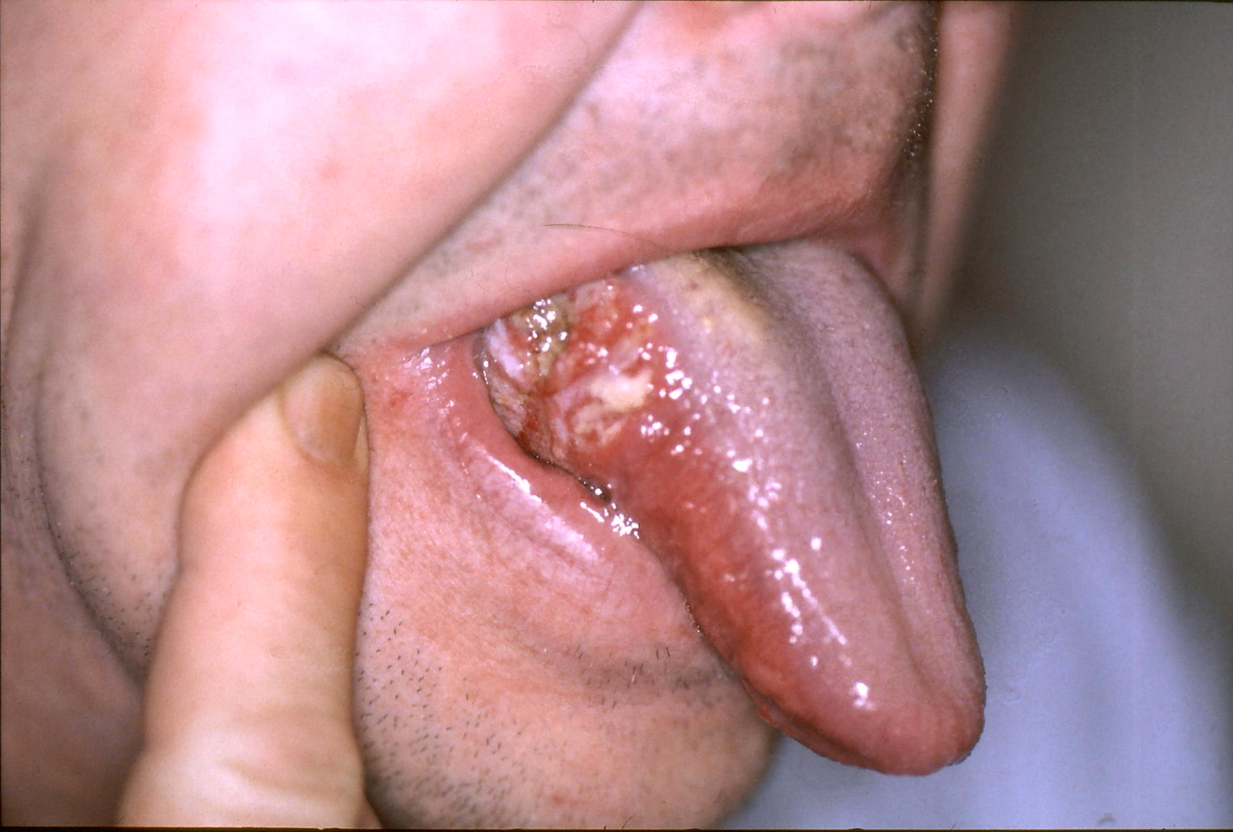 Oral cancer
