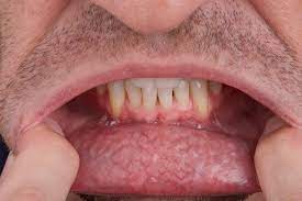 Oral cancer