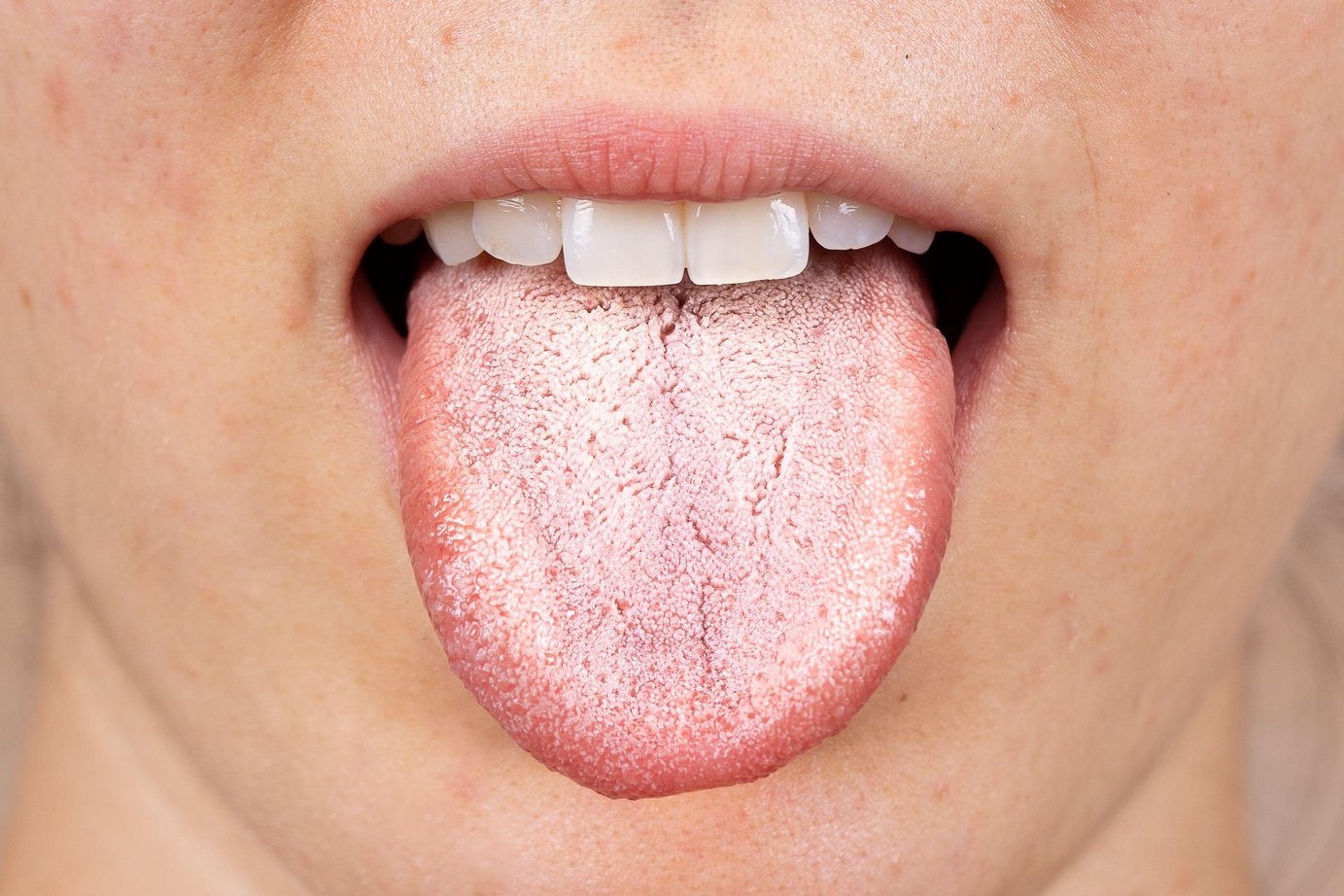 Oral thrush