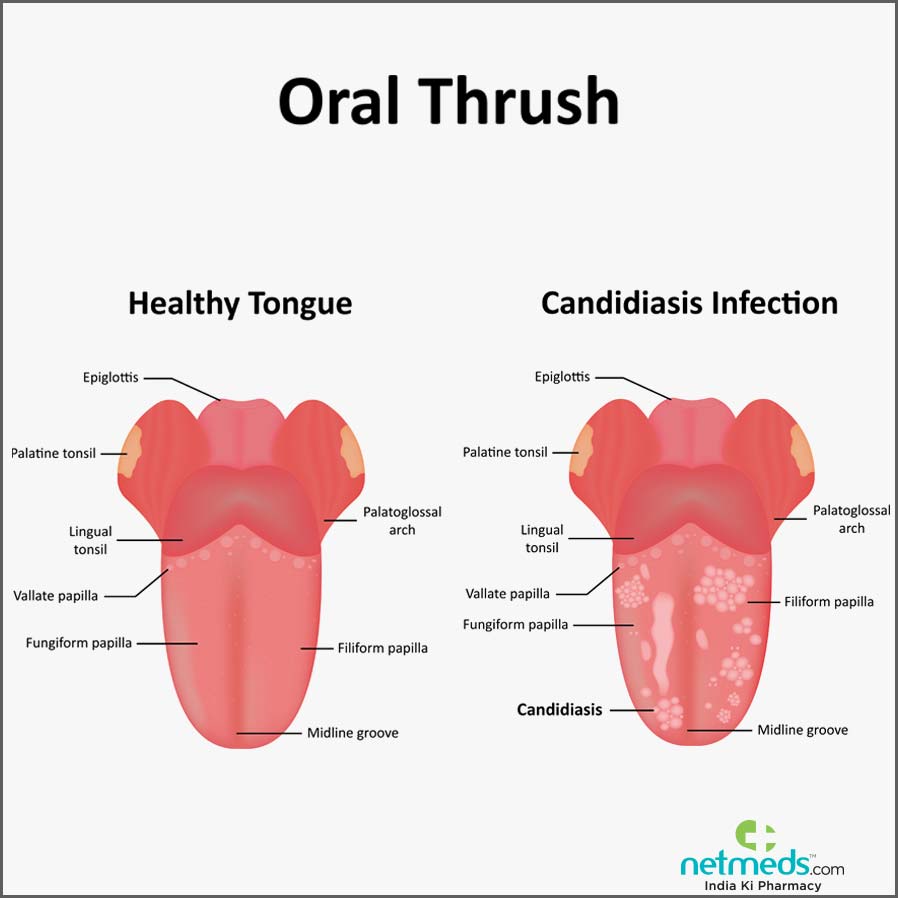 Oral thrush