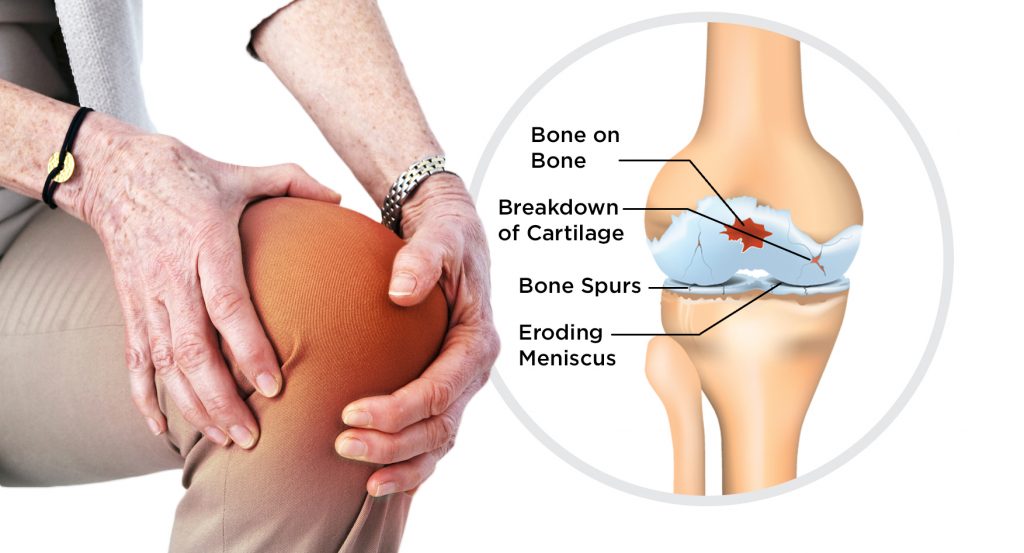 Osteoarthritis