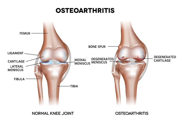 Osteoarthritis