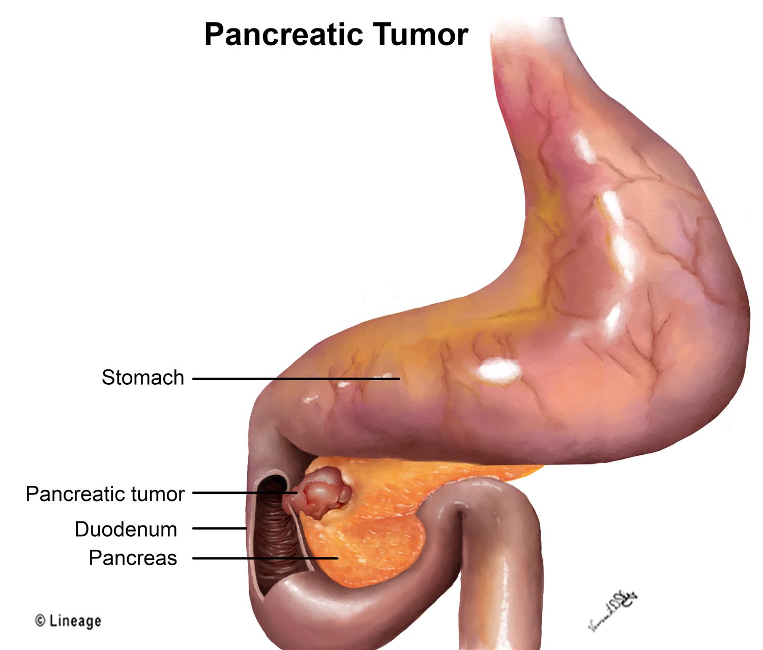 Pancreatic cancer