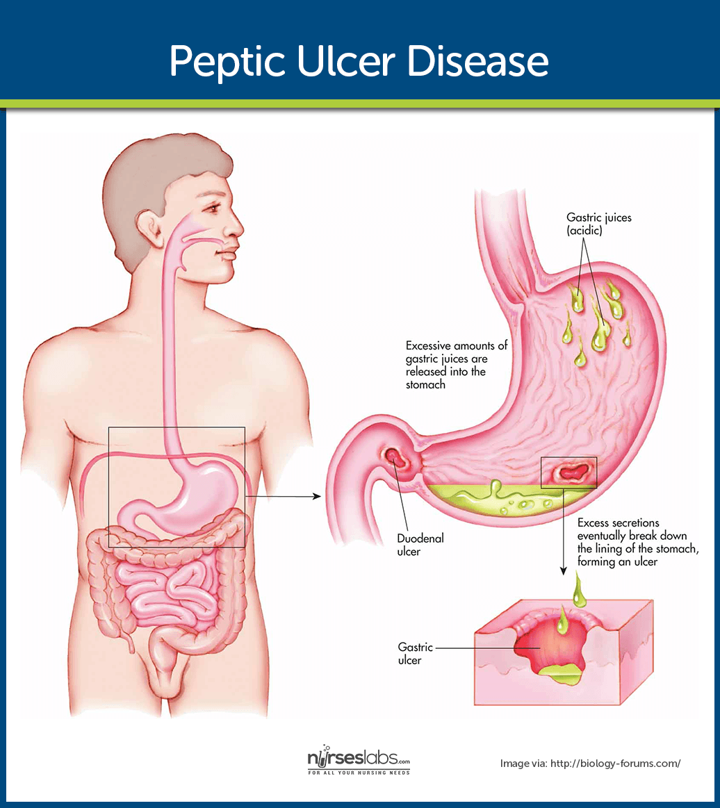 Peptic ulcer disease