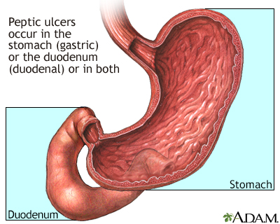 Peptic ulcer disease