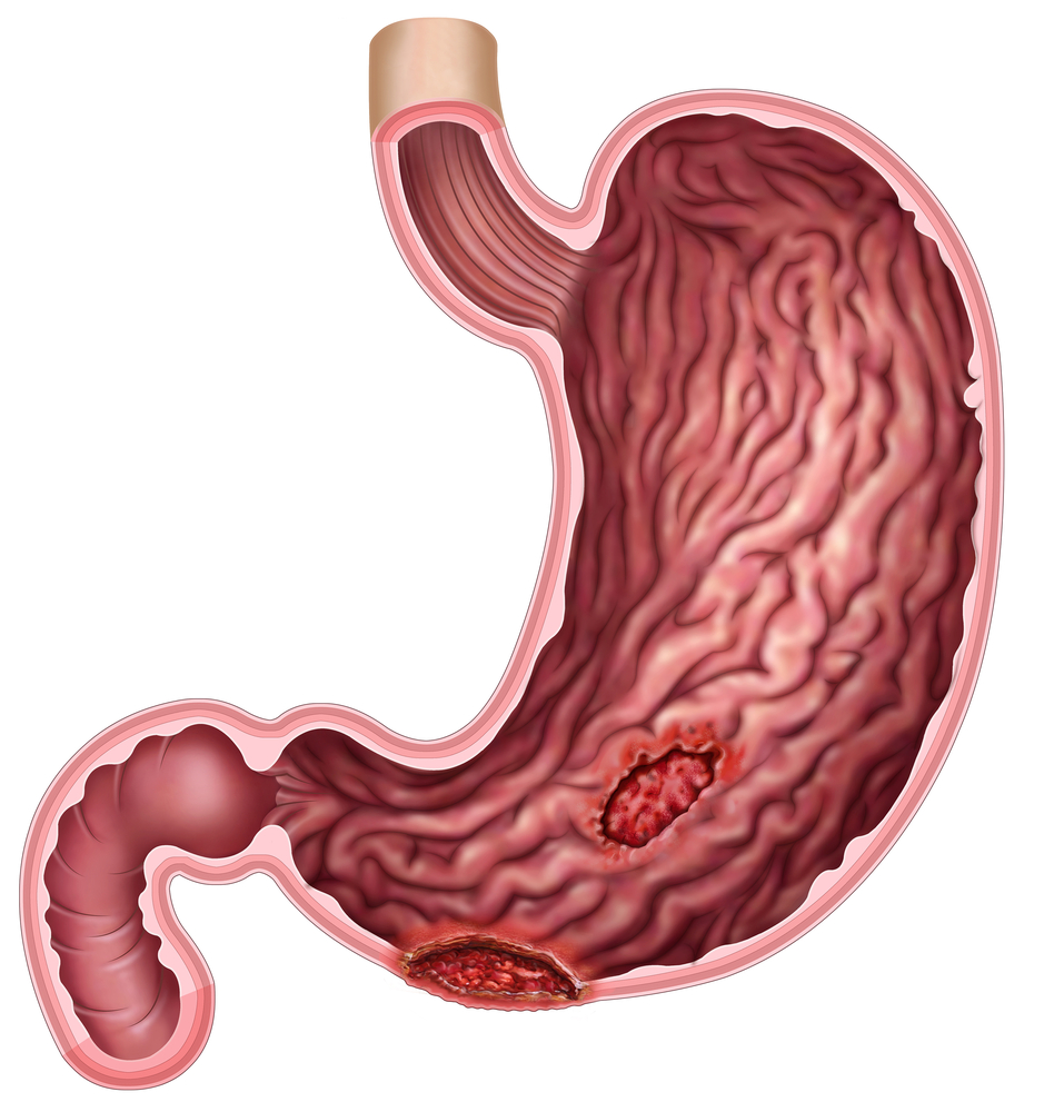 Peptic ulcer disease