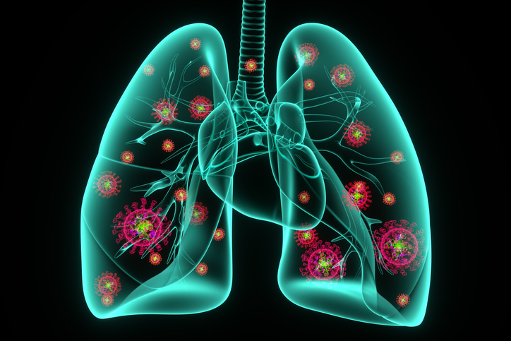 Pneumonia