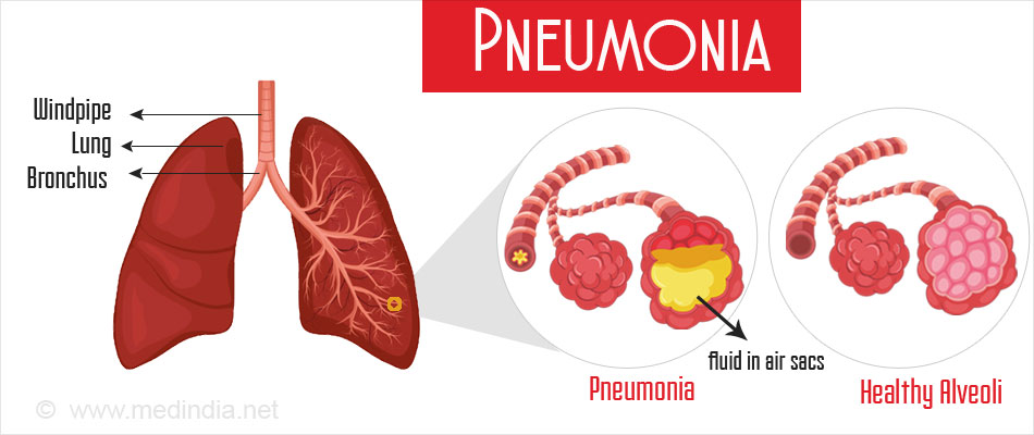 Pneumonia