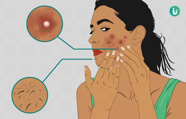 Polycystic ovarian syndrome (PCOS)