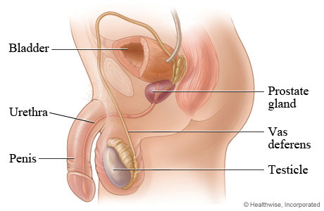 Prostate cancer