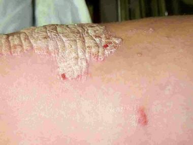 Psoriasis
