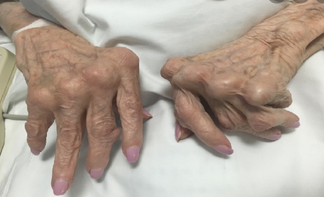Rheumatoid arthritis