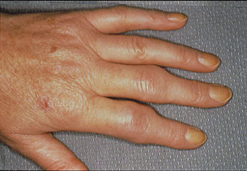 Rheumatoid arthritis