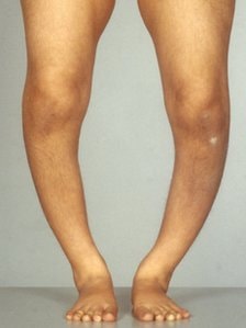 Rickets