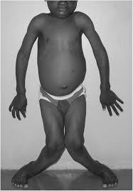 Rickets