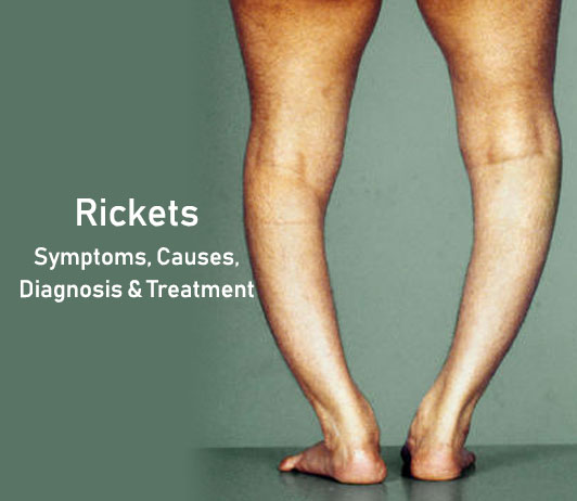 Rickets