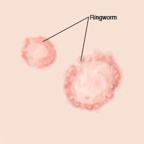 Ringworm