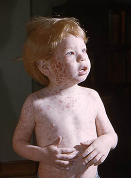 Rubella