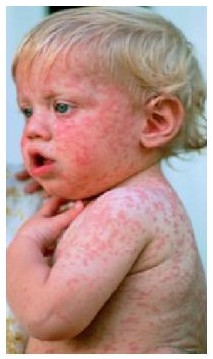 Rubella