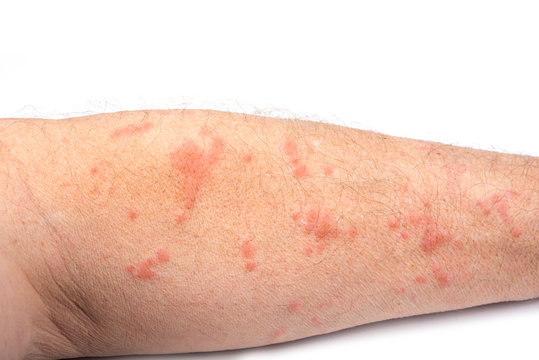 Scabies