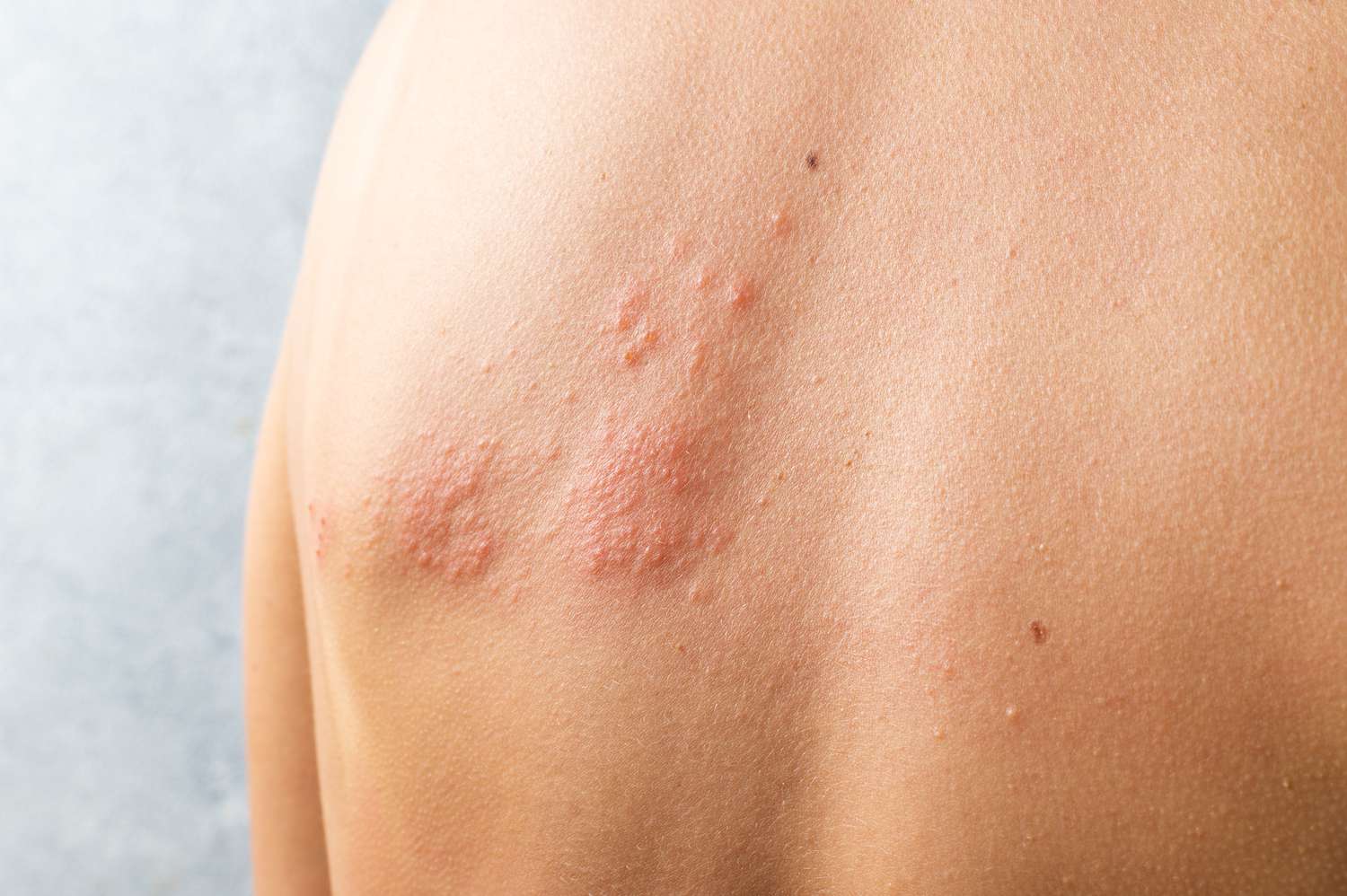 Scabies