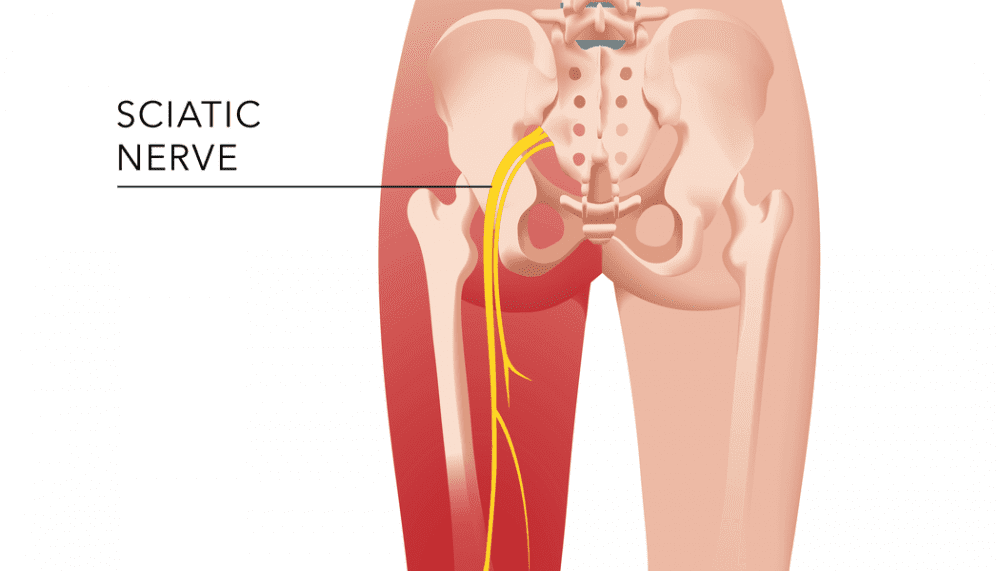 Sciatica