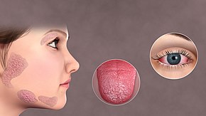 Sjogren's Syndrome