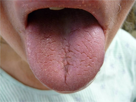 Sjogren's Syndrome