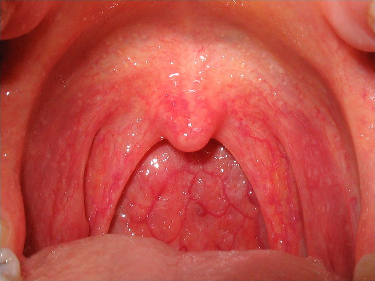 Sore throat