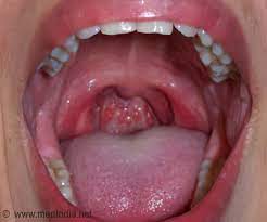 Sore throat