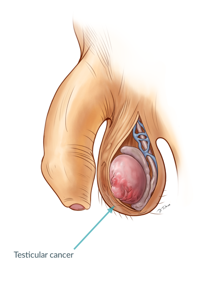 Testicular cancer