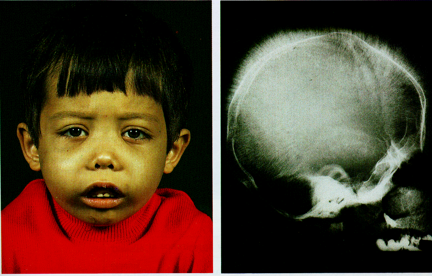 Thalassemia