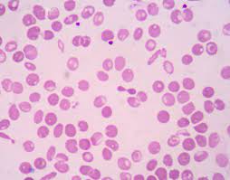 Thalassemia