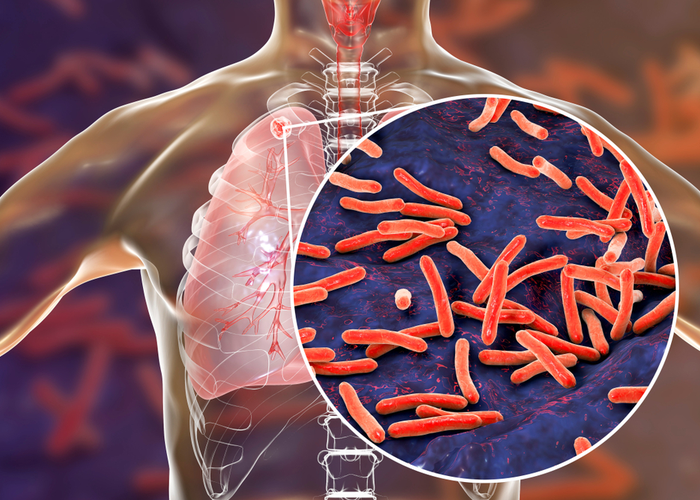 Tuberculosis (TB)
