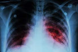 Tuberculosis (TB)