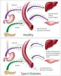Type 2 diabetes mellitus