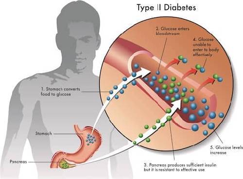 Type 2 diabetes mellitus