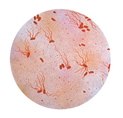 Typhoid fever