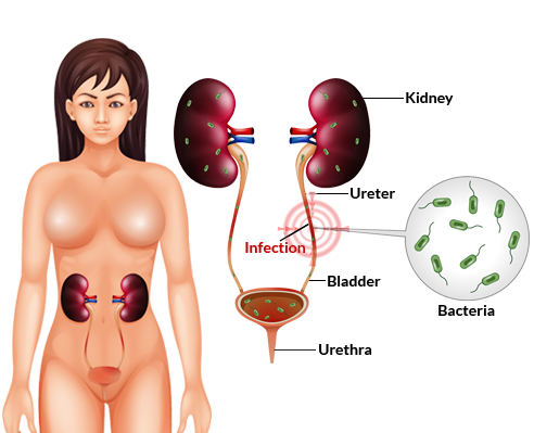 Urinary tract infections (UTIs)