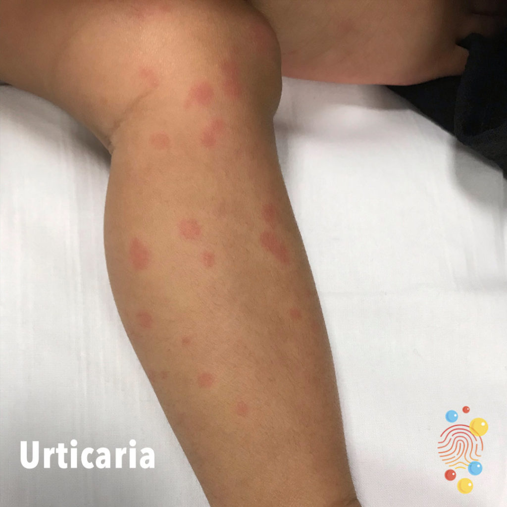 Urticaria