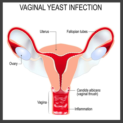 Vaginal yeast infection