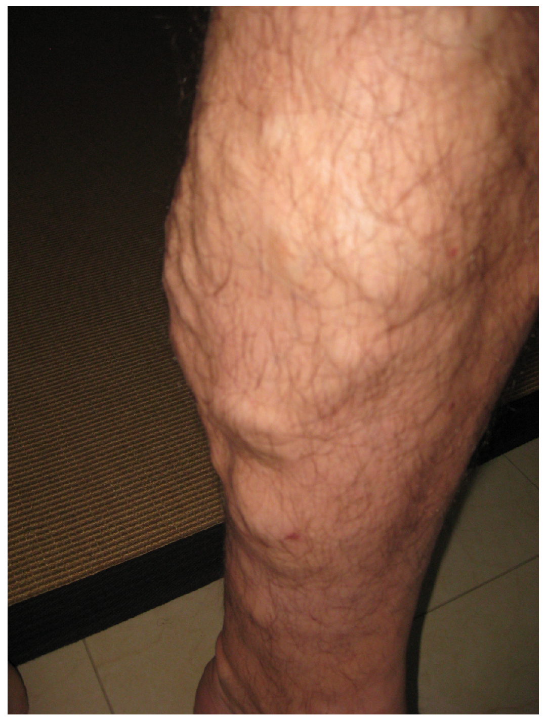 Varicose veins