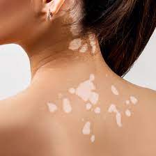 Vitiligo