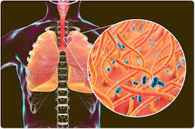Whooping cough