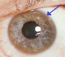 Wilson's disease