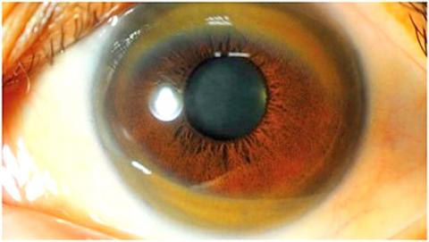 Wilson's disease